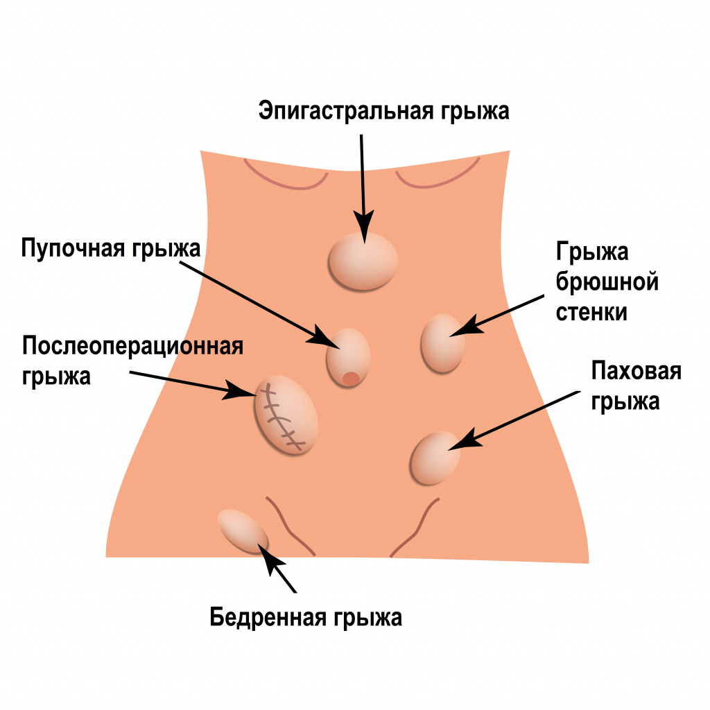 Грыжи