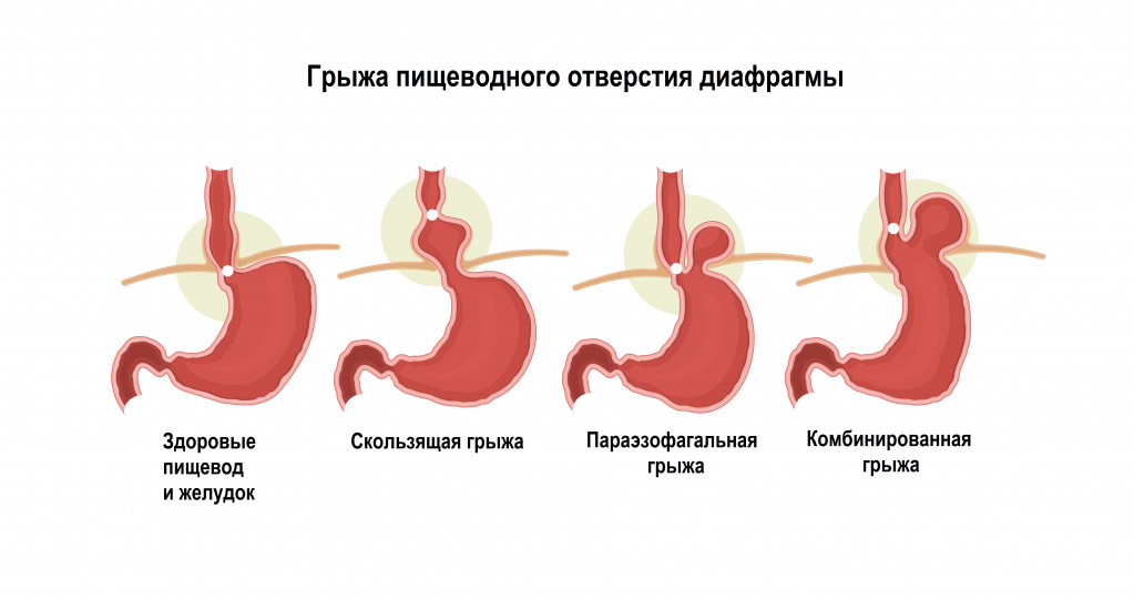 Грыжи