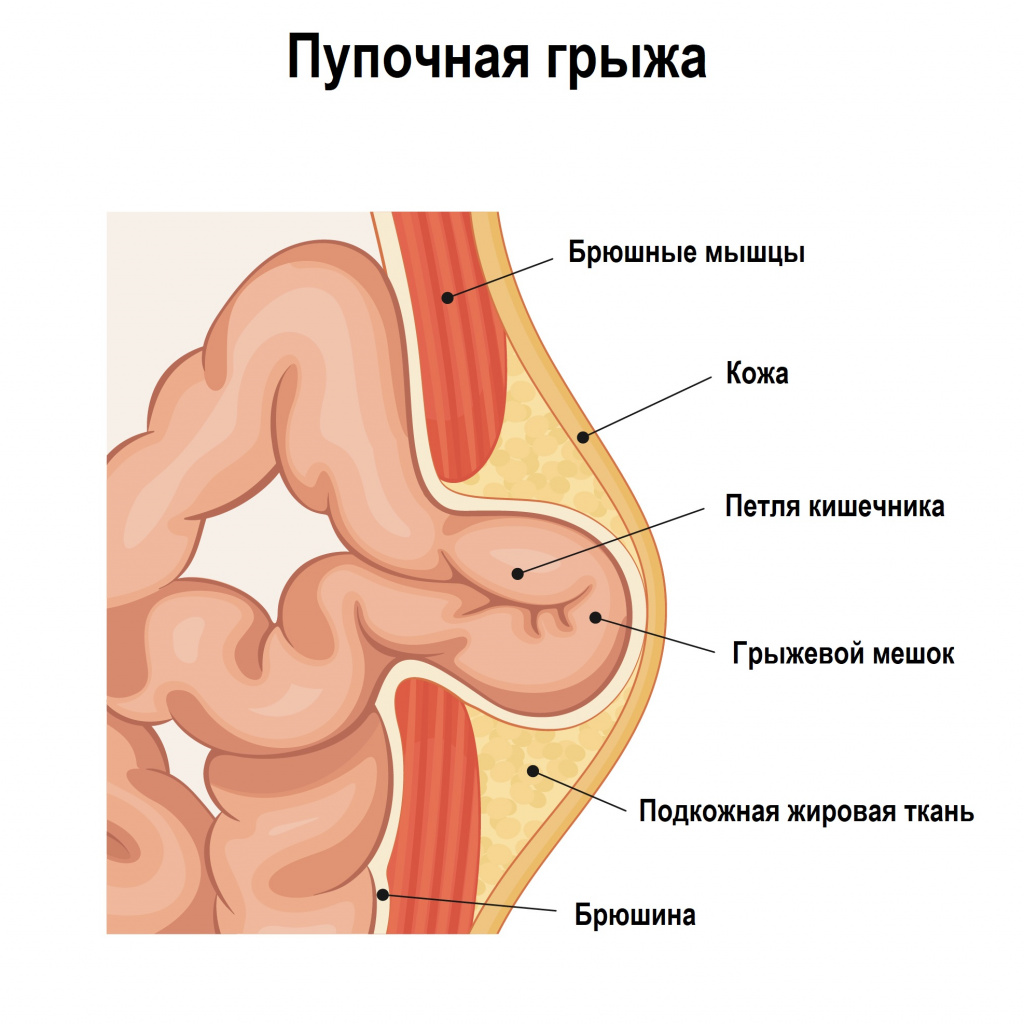 Грыжи