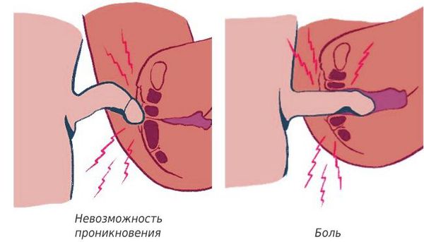 Вагинизм