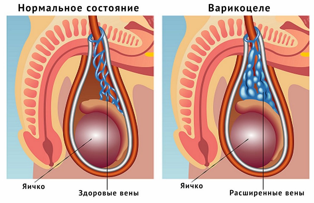 Варикоцеле