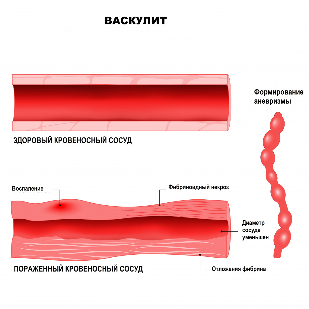 Васкулит