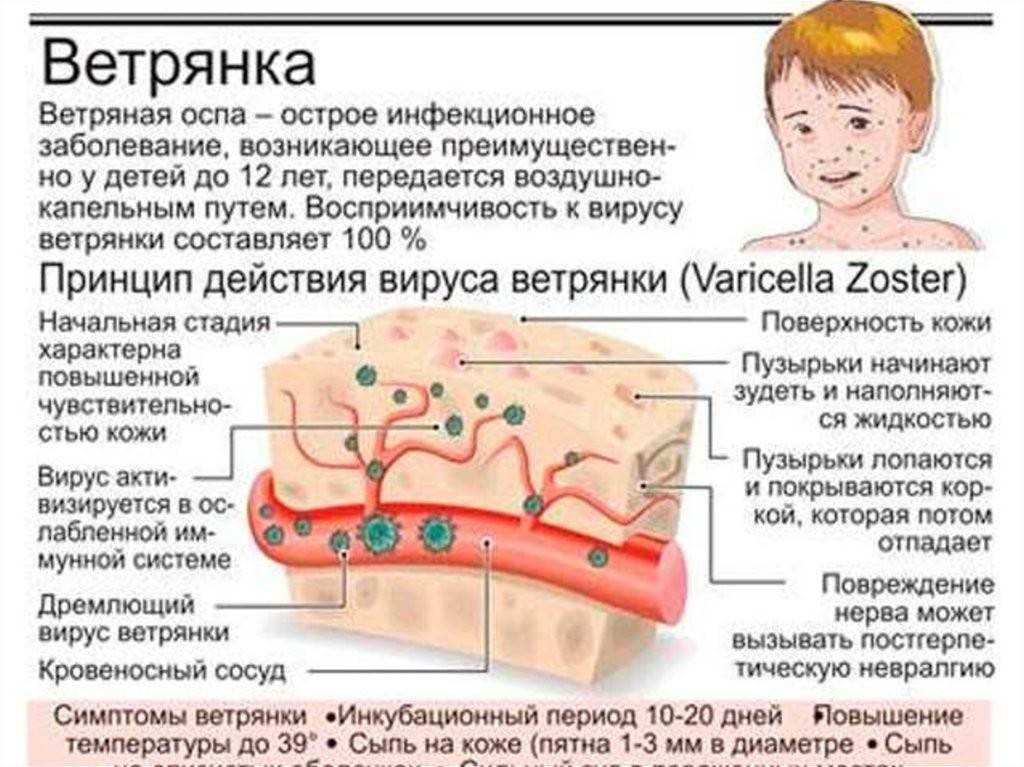 Ветряная оспа