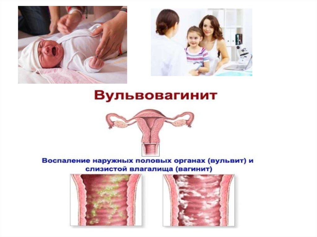 Вульвовагинит